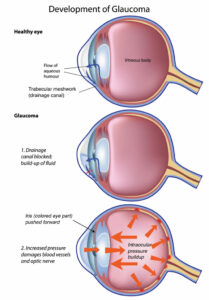 What is Glaucoma?