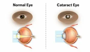 Working of Cataract Surgery Lens 