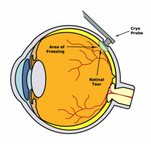 cryopexy damaged retina treatment