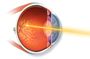 damaged retina treatment