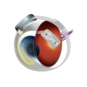 damaged retina treatment