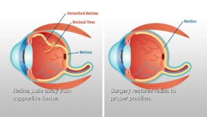 retina treatment cost
