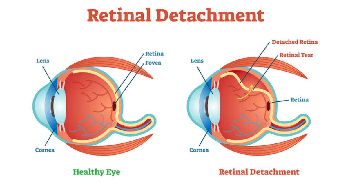 Retinal Detachment Treatment