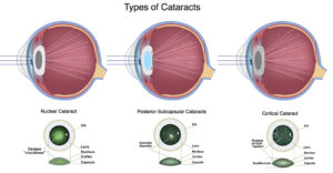 types of cataract