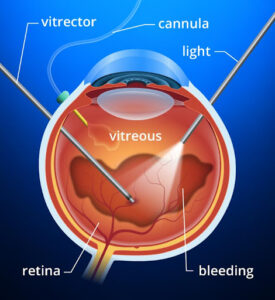 vitrectomy damaged retina treatment