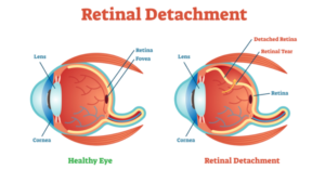 Retinal Detachment Treatment