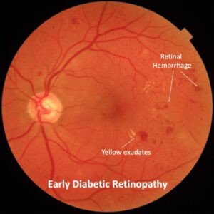 प्रारंभिक डायबिटीज रेटिनोपैथी(Early diabetic retinopathy)