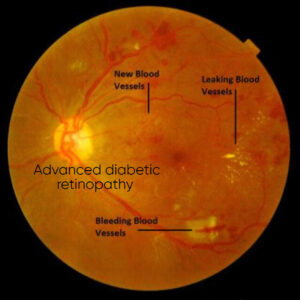 उन्नत डायाबेटिक रेटिनोपैथी(Advanced diabetic retinopathy)