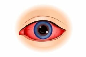 डायाबेटिक मोतियाबिंद के लक्षण- Symptoms of Diabetic Cataract in Hindi