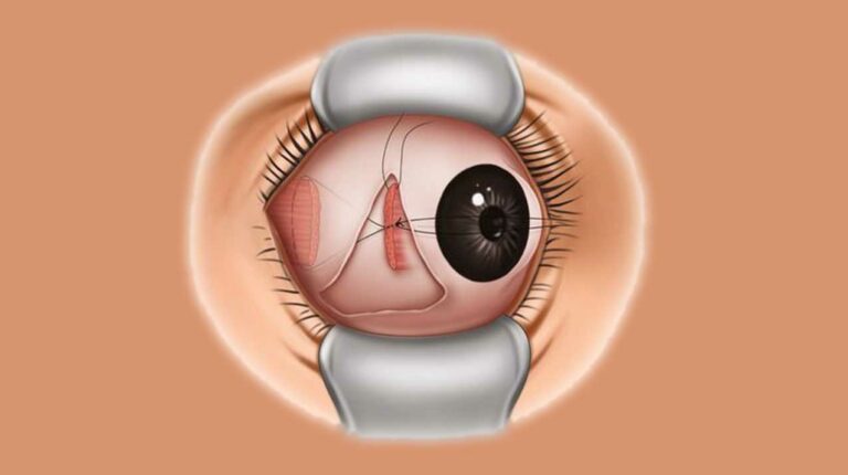 Ahmedabads Best Squint Doctor How To Correct Your Vision Problems 