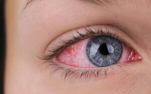 बढ़ा हुआ आंख का दबाव- Increased eye pressure