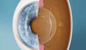 Visian ICL: Meaning, Types, Benefits And Complications