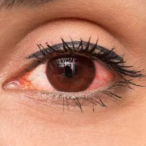 Eye pain or red eye