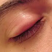 Inflammation-eye