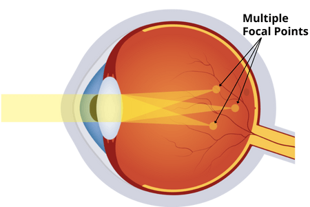astigmatism_vision