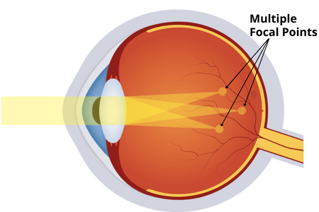 astigmatism vision