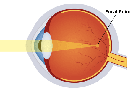 myopia-vision