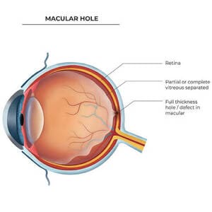 macular-hole