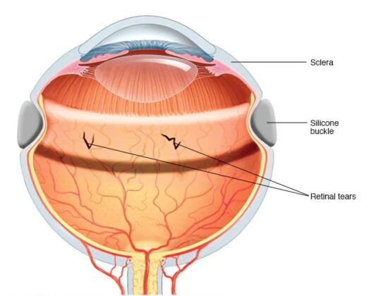scleral-buckling