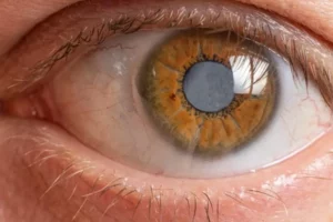 Cataract Home Remedies