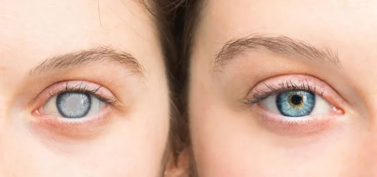 Common Myths About LASIK and The Reality