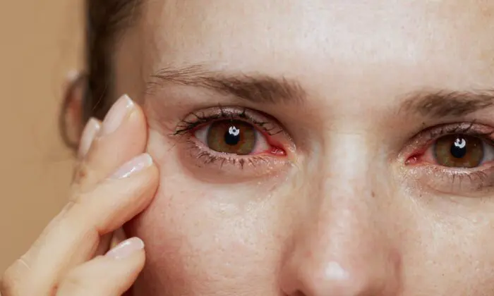 Dry Eye Treatment