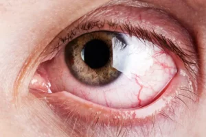 Introduction to Corneal Abrasion