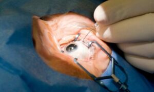 Is ICL Surgery Painful-Breaking Down the Reality