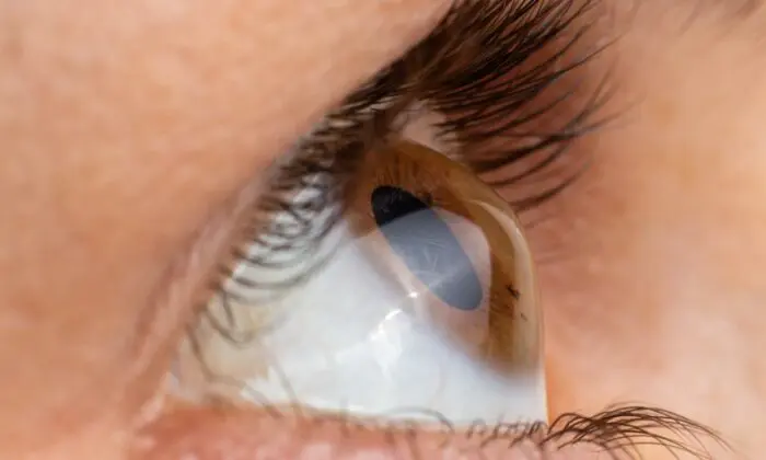 Keratoconus symptoms