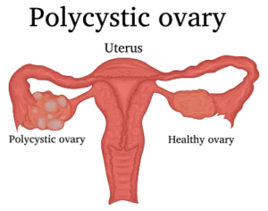 PCOS-A Quick Overview