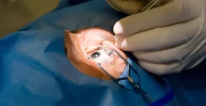 The Cataract Surgery Procedure