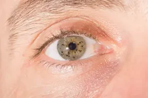 The Underlying Causes of Choroidal Nevus