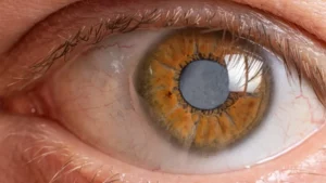 Understanding the Basics of a Cataract