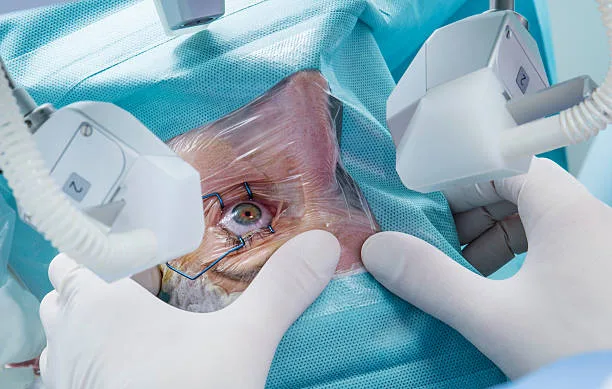 Unveiling the Disadvantages of LASIK Surgery