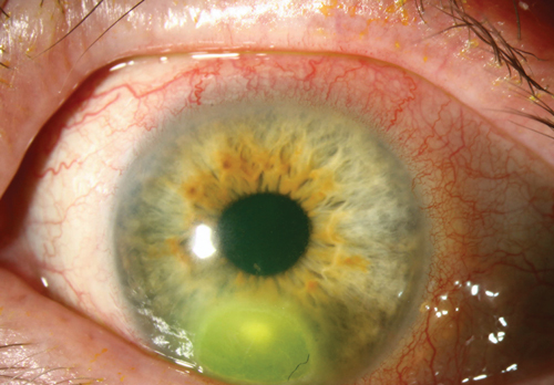 Corneal Infection
