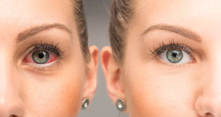 Common Post-LASIK Symptoms & Tips To Manage Them