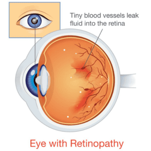 Diabetic Retinopathy Stages