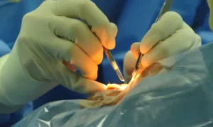 What Happens in Vitrectomy Surgery