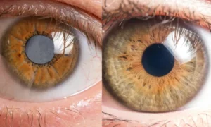 Cataracts Vs Glaucoma