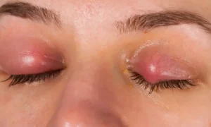 Understanding Chalazion-Causes and Symptoms