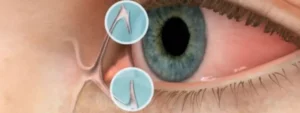 Surgical Options for Dry Eyes Treatment in Delhi-Punctal Plugs