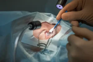 Best Hospital for Smart Surf LASIK Surgery in Delhi