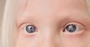 What Are Congenital Cataracts