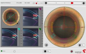 What is Femtosecond Laser-Assisted Cataract Surgery (FLACS)_What is Femtosecond Laser-Assisted Cataract Surgery (FLACS)