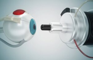 neo femto cataract surgery