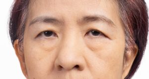 get rid of bags under eyes