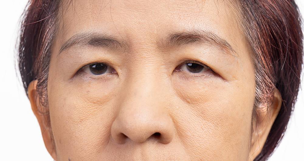 get rid of bags under eyes