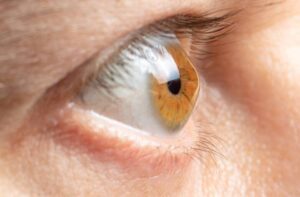 Stop Keratoconus Progression