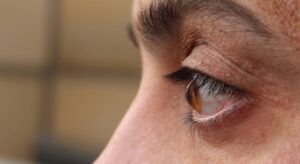 What Is Keratoconus and How Does It Progress