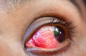 epi contoura side effects